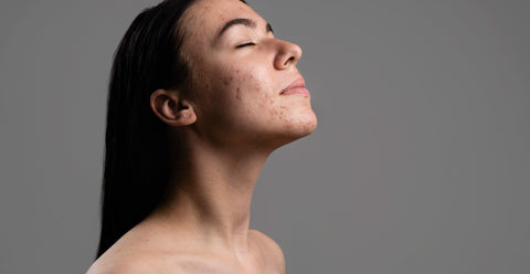 How do you remove dark spots?